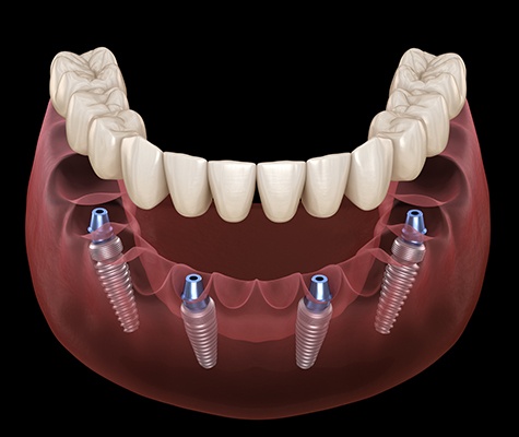 Animated all on four dental implant denture