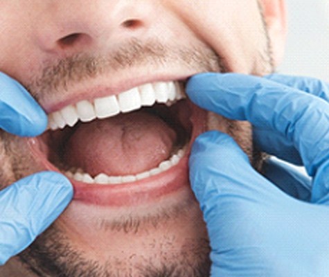 Considering patient for teeth whitening in Lancaster
