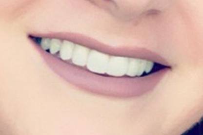 Closeup of Abigails' smile after dental treatment
