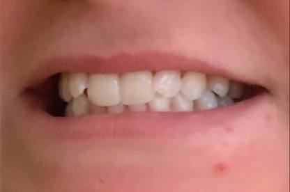 Closeup of Abigail's smile before dental treatment