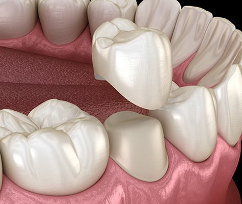 Animated smile during dental crown placement