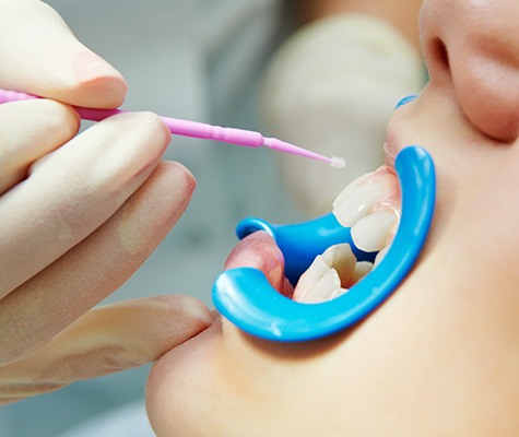 Patient receiving silver diamine fluoride treatment