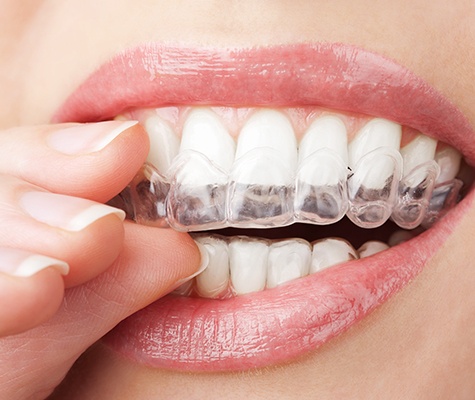 Closeup of patient placing an Invisalign tray