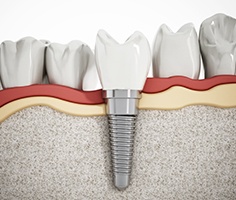 Animated smile with dental implant supported replacement tooth