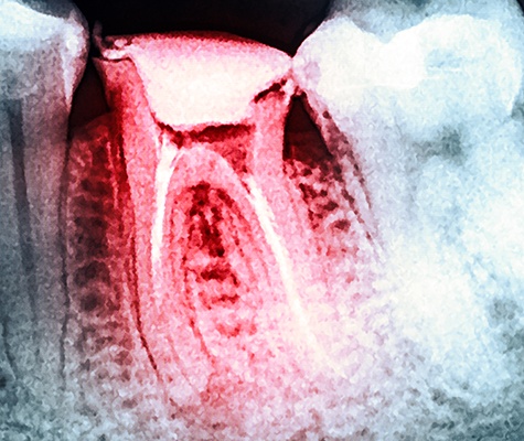 X-ray of damaged tooth that needs to be extracted
