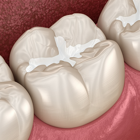 Illustration of tooth with tooth-colored filling