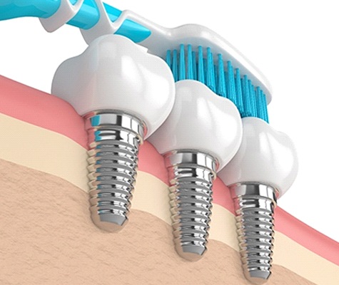 toothbrush cleaning dental implants in Lancaster