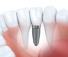 animated smile with dental implant supported dental crown
