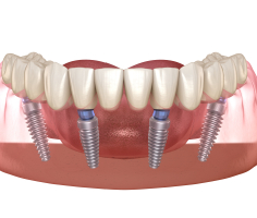 Animated smile with dental implant supported denture