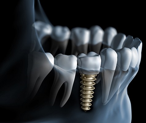 X-ray diagram of dental implants in Lancaster