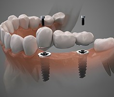 Diagram showing implant bridge replacing multiple missing teeth in Lancaster