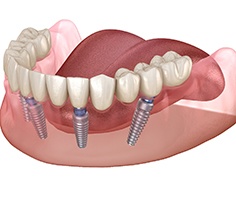 Diagram showing an all-on-4 implant denture in Lancaster