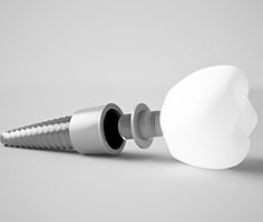 Parts of an implant that impact price of dental implants