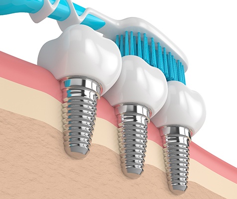 Diagram of toothbrush brushing dental implants