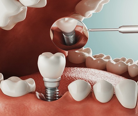 diagram of how dental implants in Lancaster are placed