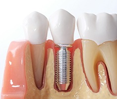 model showing dental implants in Lancaster during osseointegration