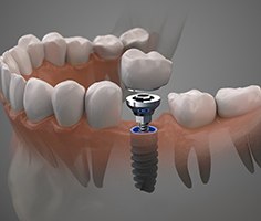 Diagram showing single tooth dental implant in Lancaster