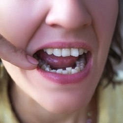 Closeup of woman before Invisalign in Lancaster