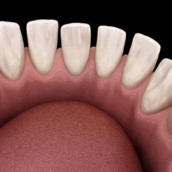 Diagram showing gaps between teeth before Invisalign in Lancaster