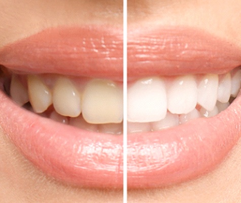 Before and after teeth whitening in Lancaster