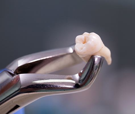 Metal clasp holding extracted wisdom tooth
