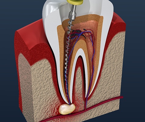 Illustration of root canal treatment process