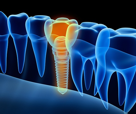 Animated dental implant supported dental crown