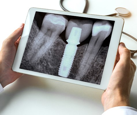 X-ray of dental implant supported dental crown