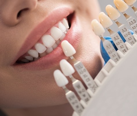 Patient's smile compared with porcelain veneer shade chart