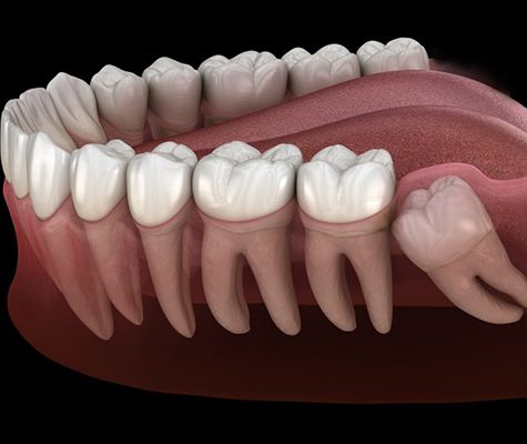 wisdom tooth growing in at awkward angle against molar 