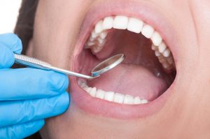 A dental crown in Lancaster can give a tooth a gorgeous makeover. 