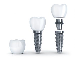 Representation of dental implant parts