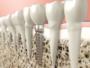 A closer look at implants in the jawbone. 