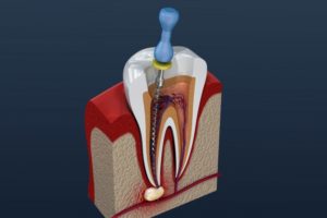 rendering of a root canal