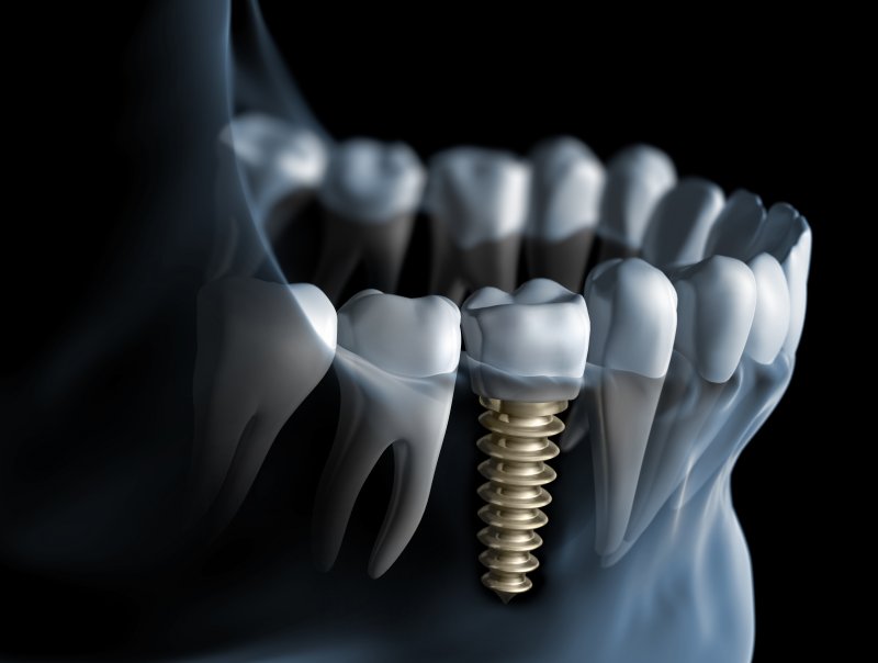 a mouth with a dental implant