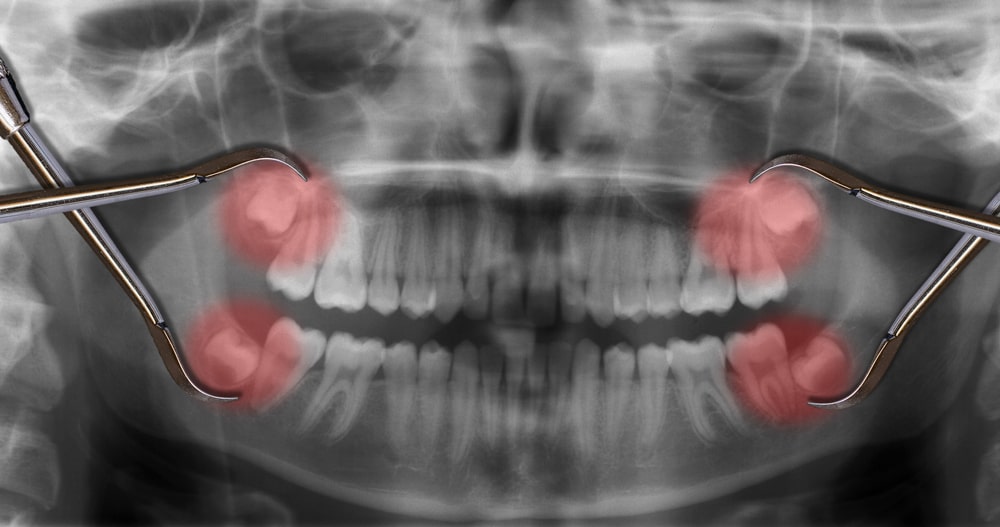 Do I Need a Wisdom Teeth Extraction Procedure? - Lancaster Family Smiles  Blog