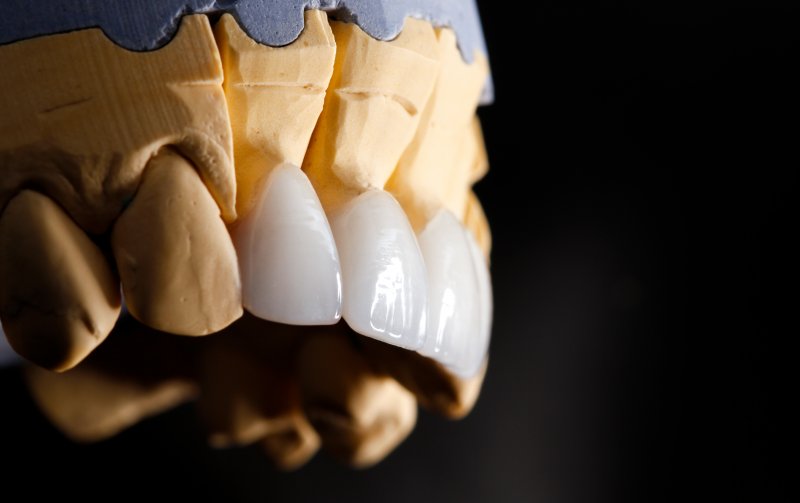 White front teeth veneers on model jaw