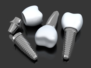 3D render of a dental implant