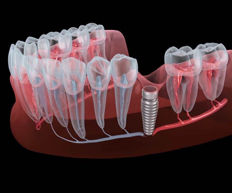 Illustration of dental implant