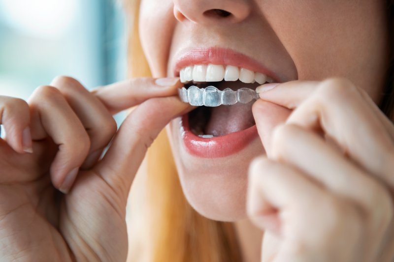 person inserting Invisalign aligner into their mouth