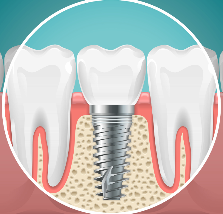 Illustrated cross section of a dental implant