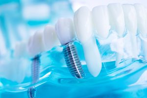 Closeup of dental implants in transparent model jaw